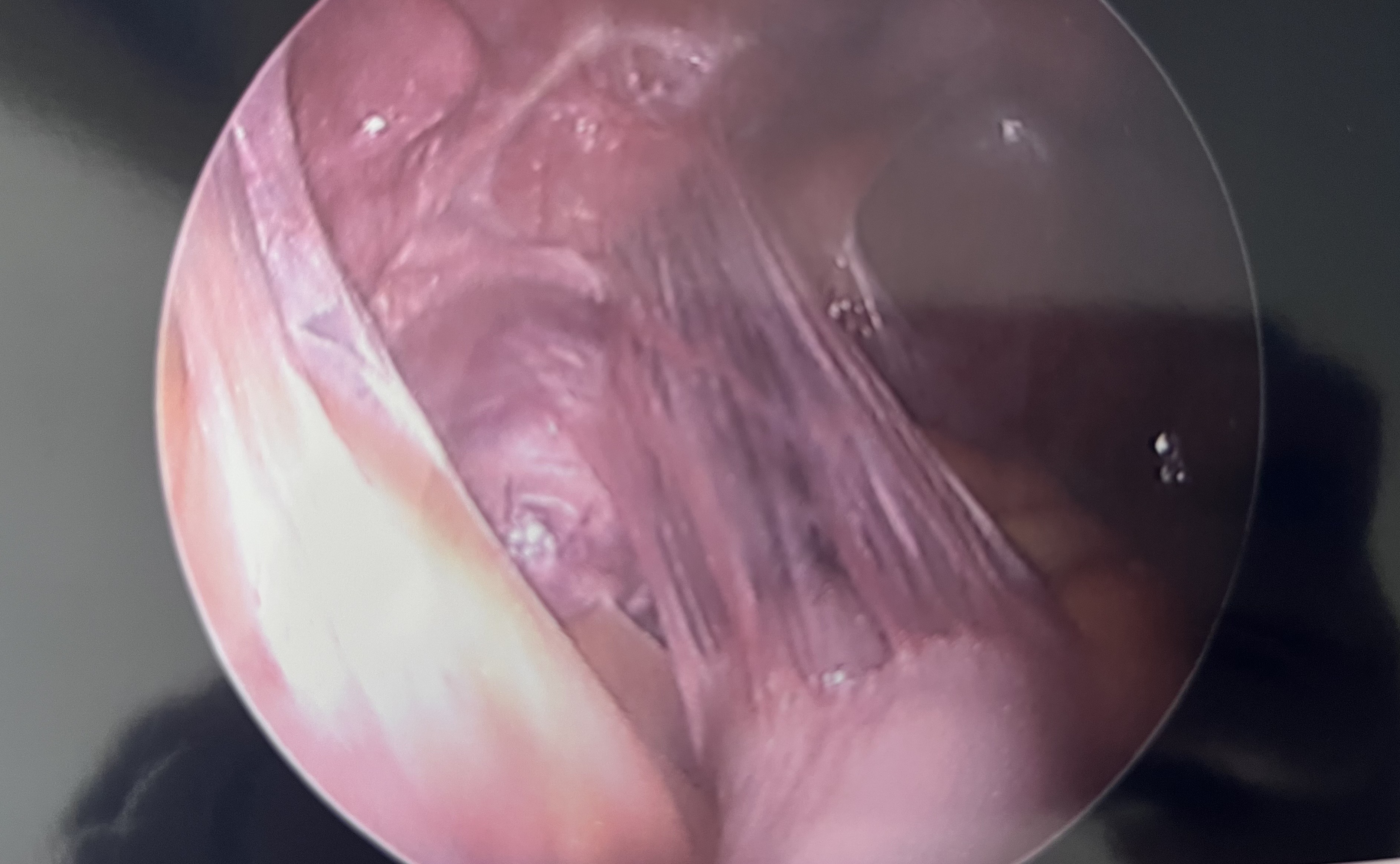 Close-Up: Dense Pelvic Adhesions